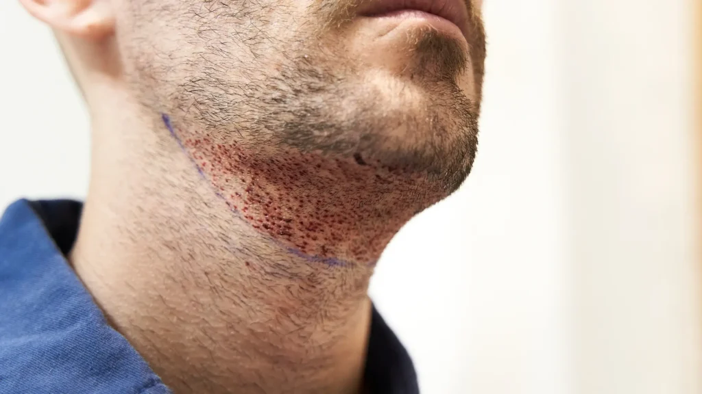 corail esthetique greffe de barbe​